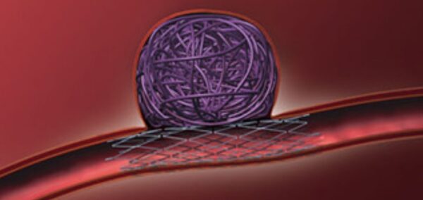 aneuriysm-thrombosis-1024x484